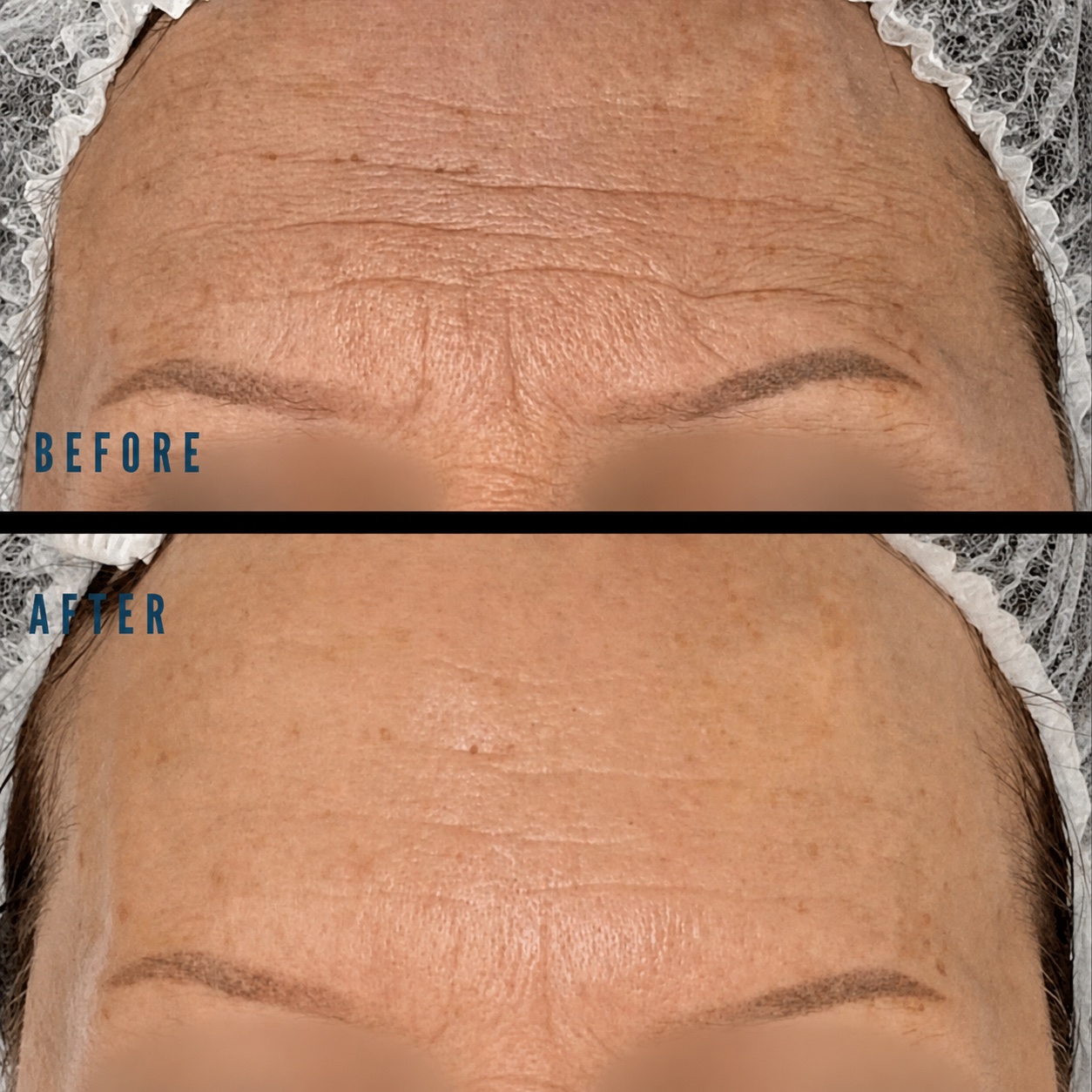 Forehead area before and after result with the client's eyes blurred for privacy