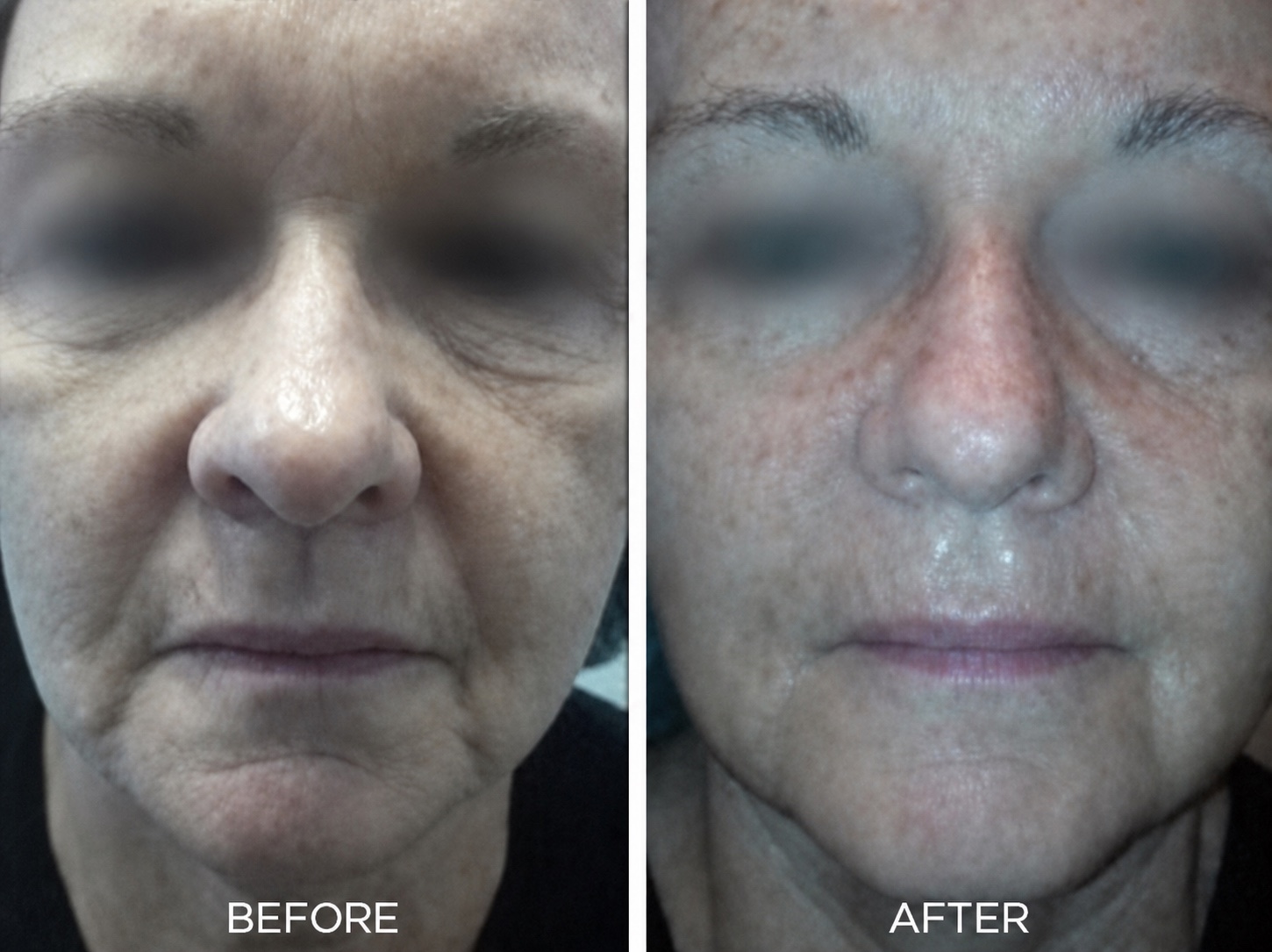 Full-face before and after result with the client's eyes blurred for privacy