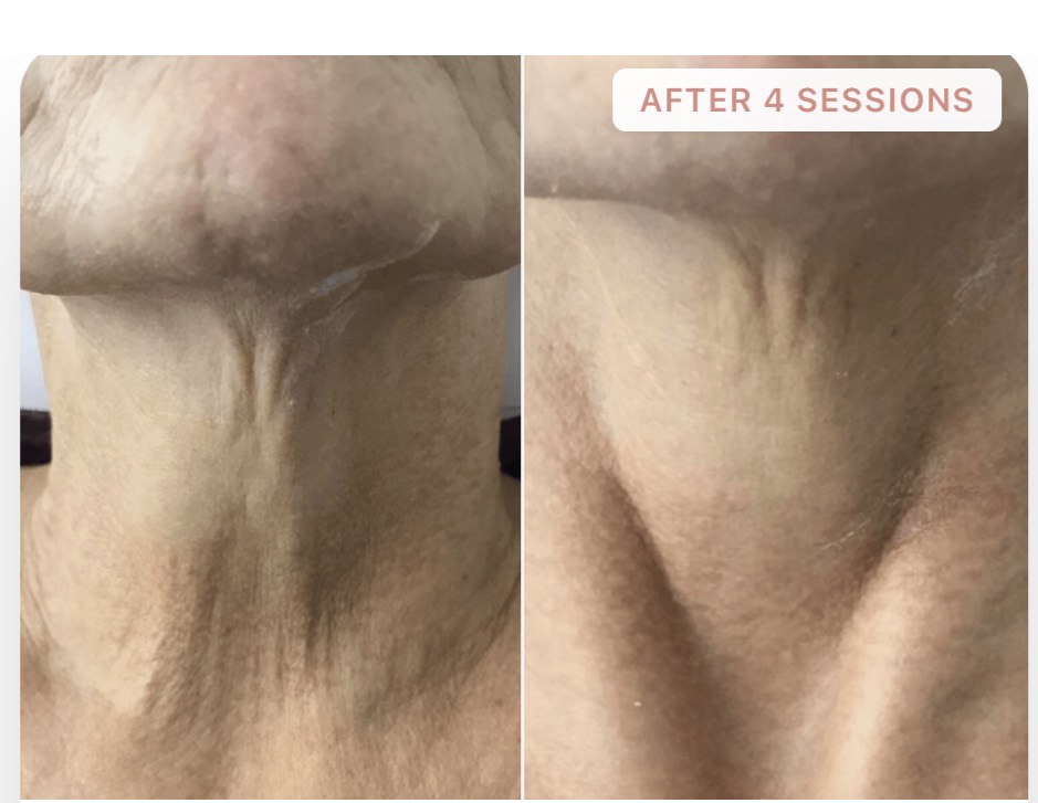 Neck area treatment comparison after four sessions