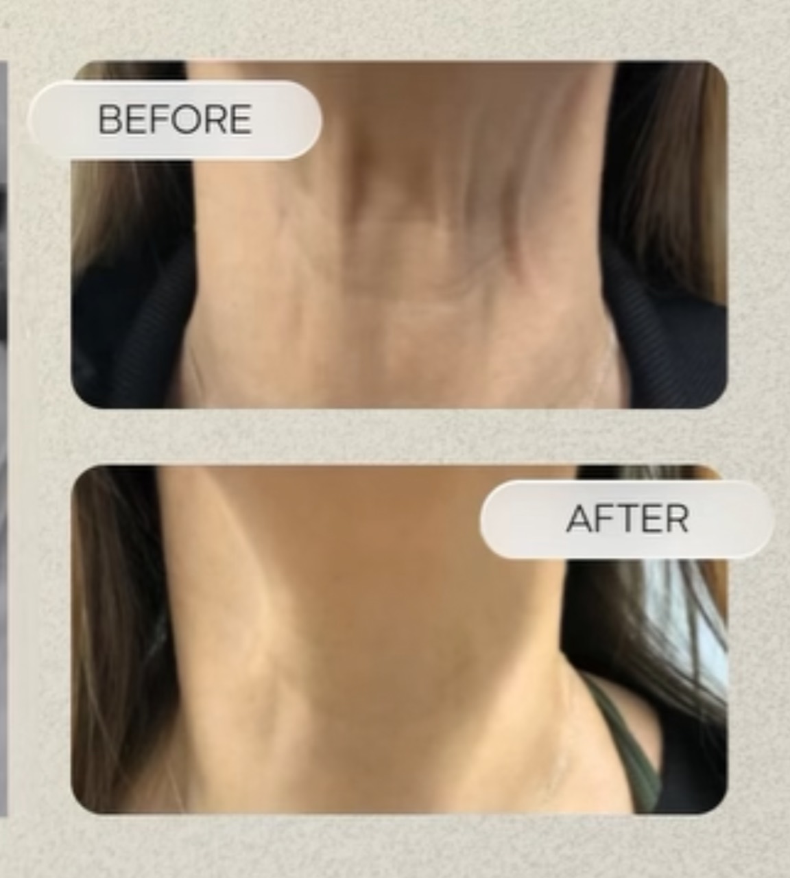 Neck area before and after treatment result